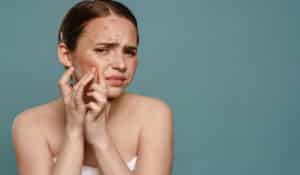 7 alimentos que provocan o empeoran el acné