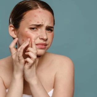 7 alimentos que provocan o empeoran el acné